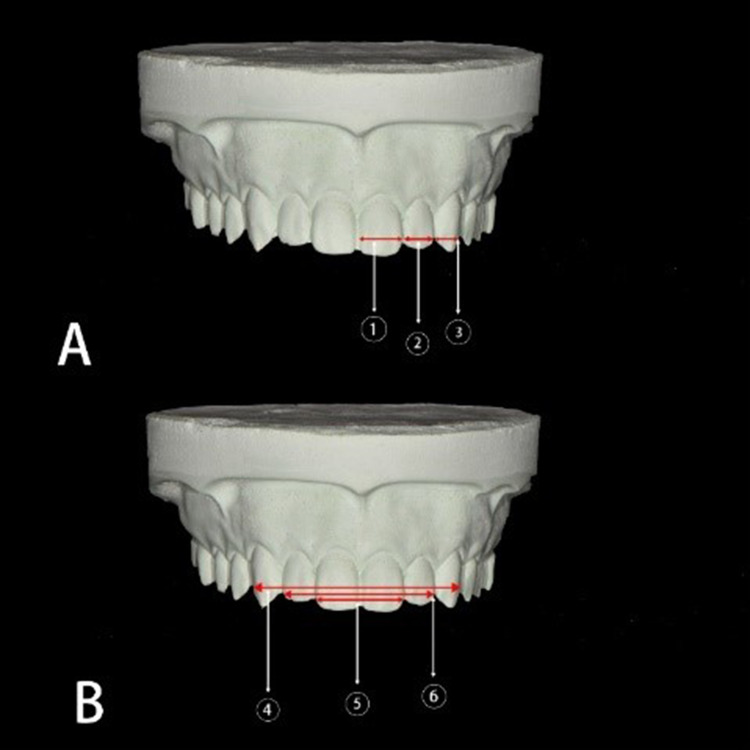 Correlation Between Maxillary Anterior Teeth and Common Facial Measurements.