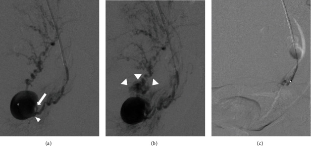 A Case of Ruptured Exophytic Uterine Artery Pseudoaneurysm without Specific Risk Factors That Manifested Seven Days after Vaginal Delivery.