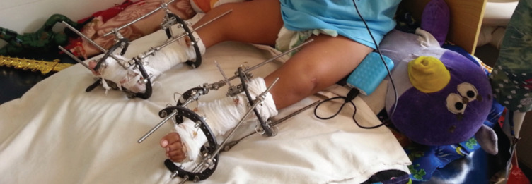 Outcomes of Management of Severe Clubfoot among Children by Ilizarov External Fixator.
