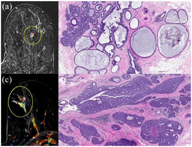 Sixteen-Year Institutional Review of Magnetic Resonance Imaging-Guided Breast Biopsies: Trends in Histologic Diagnoses With Radiologic Correlation.