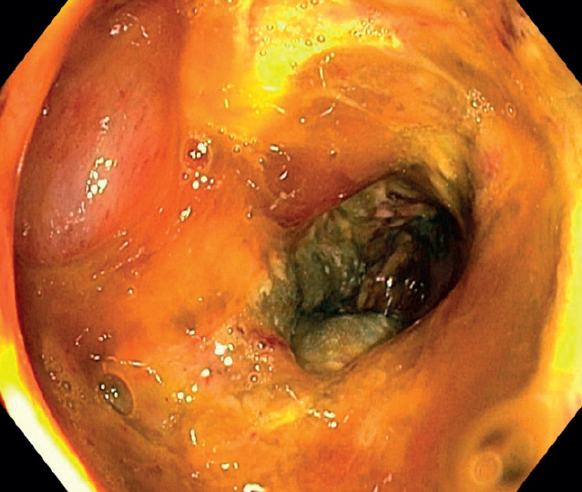Acute mercuric chloride poisoning at a potentially lethal dose ended with survival: symptoms, concentration in cerebrospinal fluid, treatment.