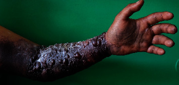 Bullous Hemorrhagic Dermatosis Induced by Enoxaparin: About a Case in Madagascar.