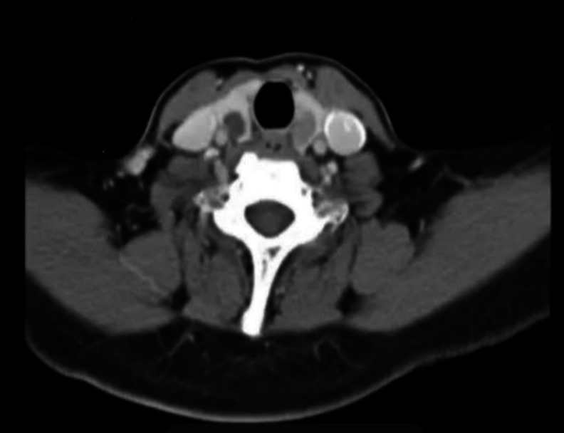 Ectopic Papillary Thyroid Carcinoma of the Posterior Pharynx.