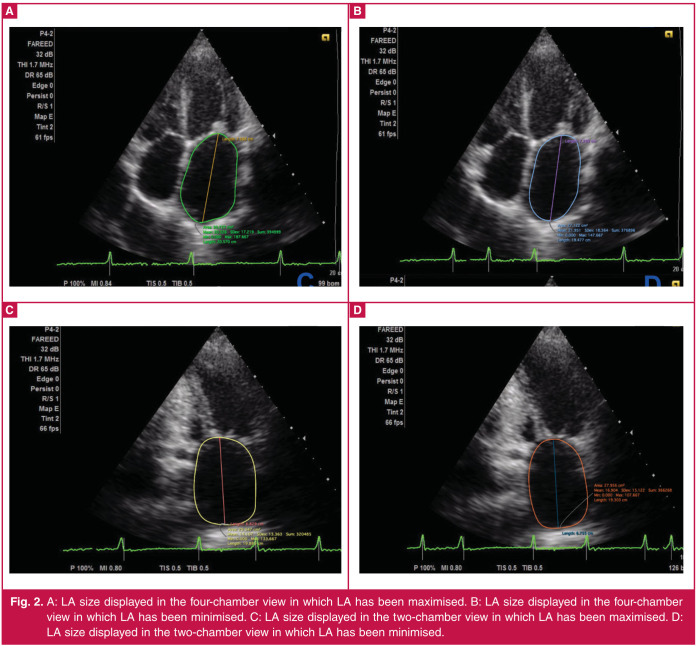 Correlation between mitral valve area and left atrial function in rheumatic mitral valve stenosis patients.