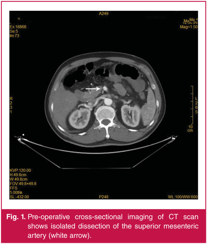 A case of spontaneous isolated superior mesenteric arterial dissection with coeliac axis stenosis.