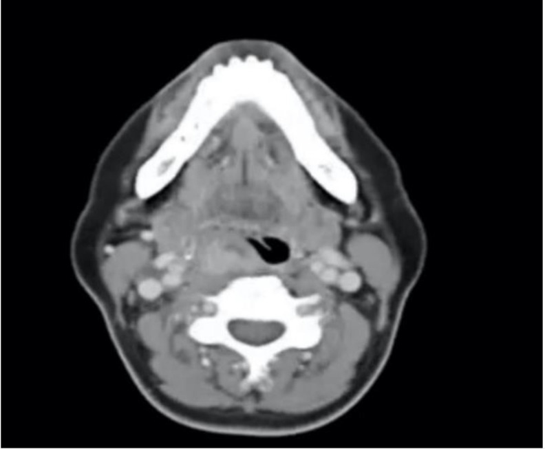 Ectopic Papillary Thyroid Carcinoma of the Posterior Pharynx.