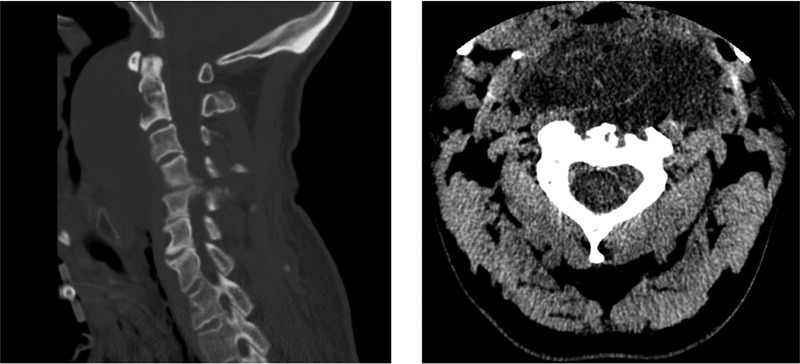 Multifocal Ectopic Recurrence of a C2 Chordoma.