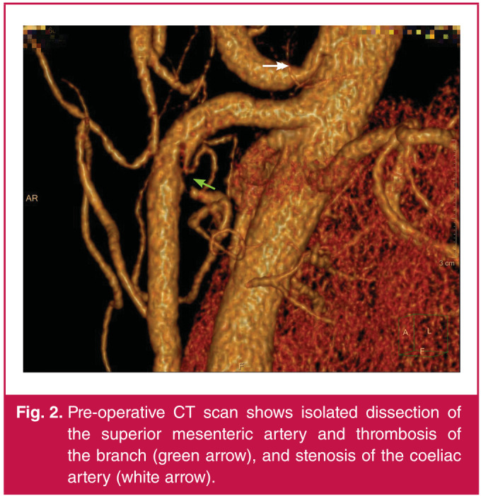 A case of spontaneous isolated superior mesenteric arterial dissection with coeliac axis stenosis.