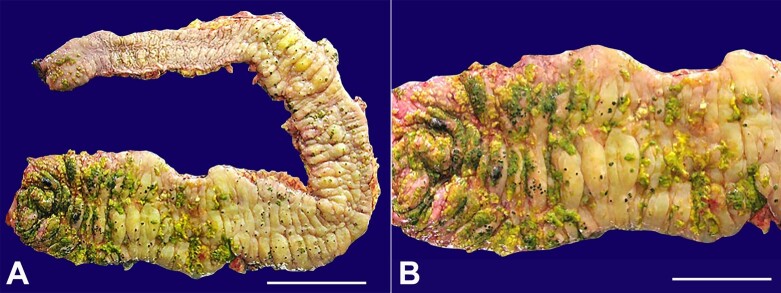 <i>Clostridioides difficile</i> infection leading to fulminant colitis with toxic megacolon.