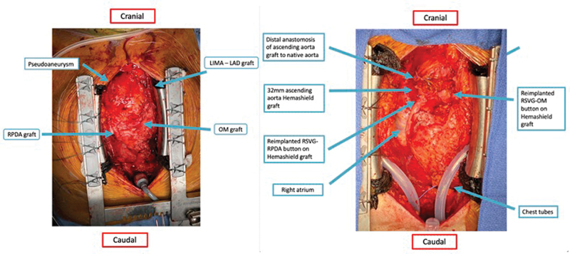 Large Ascending Aortic Pseudoaneurysm with Focal Dissection after Coronary Artery Bypass Surgery.