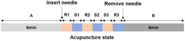 The effect of acupuncture at the <i>Taiyang</i> acupoint on visual function and EEG microstates in myopia.