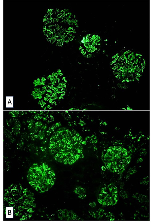 [Management of membranoproliferative glomerulonephritis secondary to infection by hepatitis C virus].