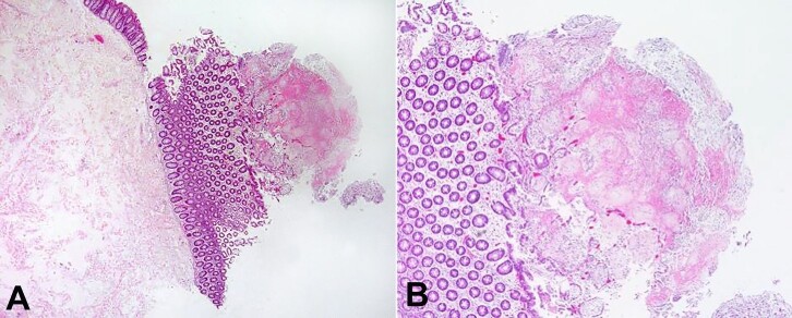 <i>Clostridioides difficile</i> infection leading to fulminant colitis with toxic megacolon.