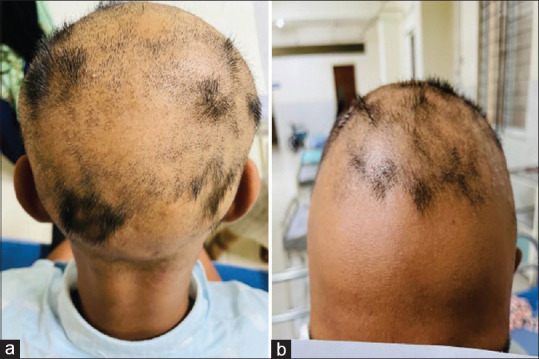 Alopecia Areata with Renal Dysgenesis.