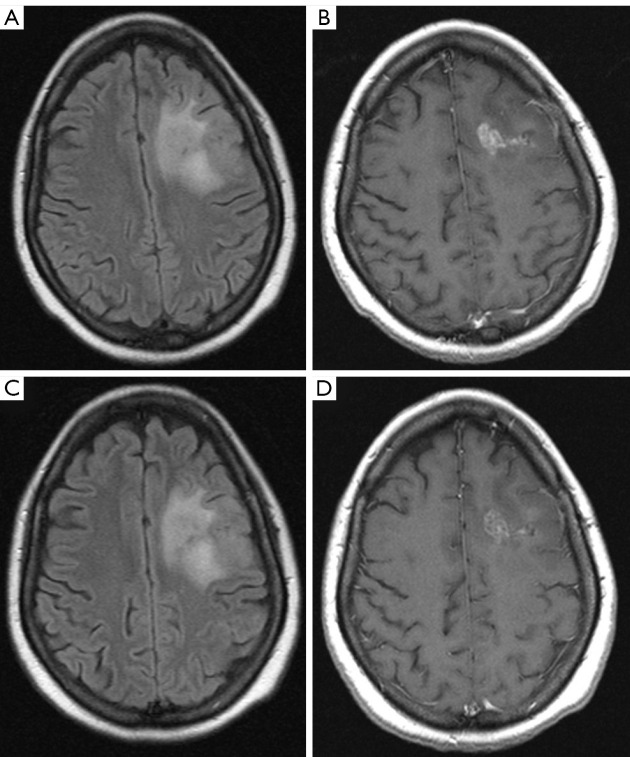 Interrater reliability of Brain Tumor Reporting and Data System (BT-RADS) in the follow up of adult primary brain tumors: a single institution experience in Italy.