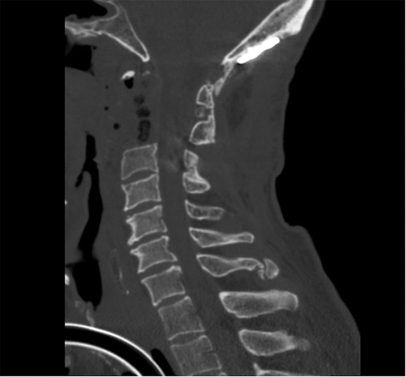 Multifocal Ectopic Recurrence of a C2 Chordoma.