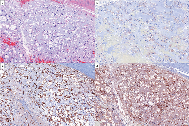 Multifocal Ectopic Recurrence of a C2 Chordoma.