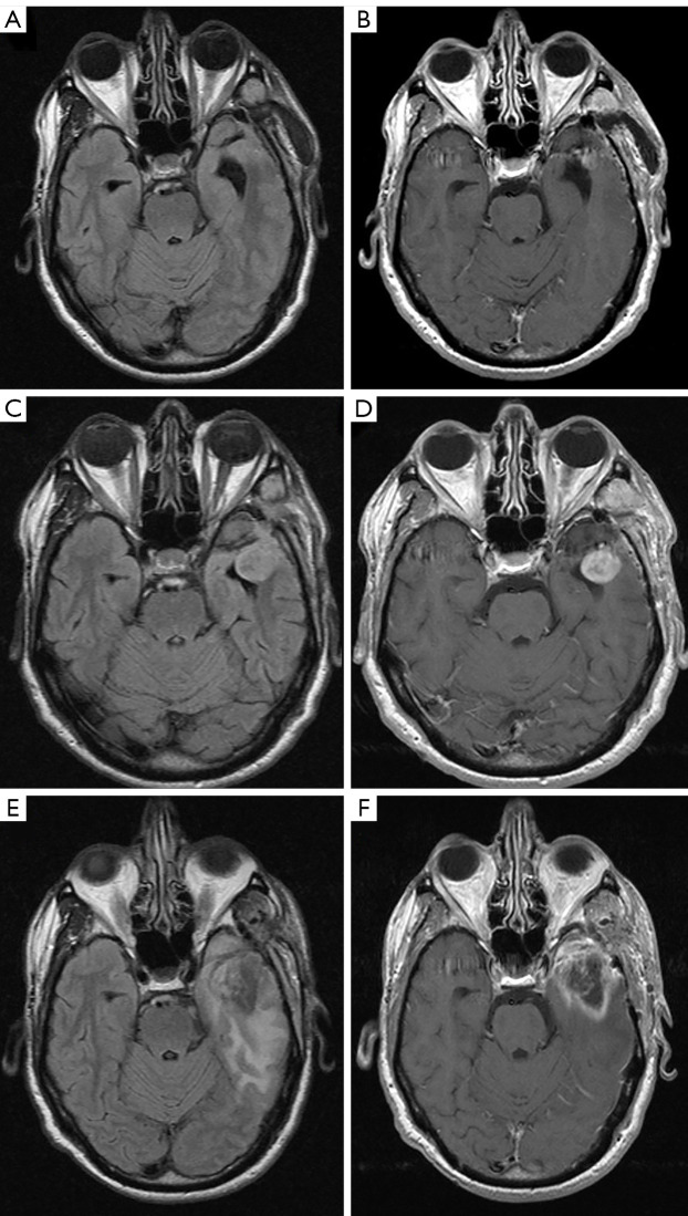 Interrater reliability of Brain Tumor Reporting and Data System (BT-RADS) in the follow up of adult primary brain tumors: a single institution experience in Italy.