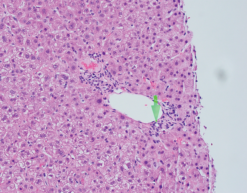 A Case of Significant Transaminitis with Liver Biopsy in a Pregnant Patient with COVID-19.