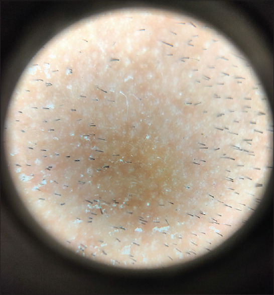 Alopecia Areata with Renal Dysgenesis.