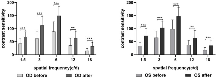 The effect of acupuncture at the <i>Taiyang</i> acupoint on visual function and EEG microstates in myopia.