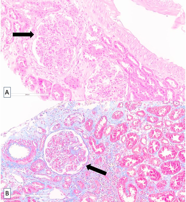 [Management of membranoproliferative glomerulonephritis secondary to infection by hepatitis C virus].