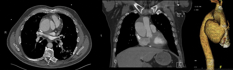 Large Ascending Aortic Pseudoaneurysm with Focal Dissection after Coronary Artery Bypass Surgery.