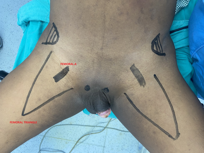 Preferring Lateral Video Endoscopic Inguinal Lymph Node Dissection Over Classic Video Endoscopic Inguinal Lymph Node Dissection in Squamous Cell Carcinoma of Penis: Lessons Learnt from Twenty-One Patients at a Single Center.
