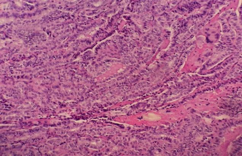 Ectopic Papillary Thyroid Carcinoma of the Posterior Pharynx.