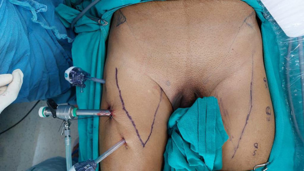 Preferring Lateral Video Endoscopic Inguinal Lymph Node Dissection Over Classic Video Endoscopic Inguinal Lymph Node Dissection in Squamous Cell Carcinoma of Penis: Lessons Learnt from Twenty-One Patients at a Single Center.