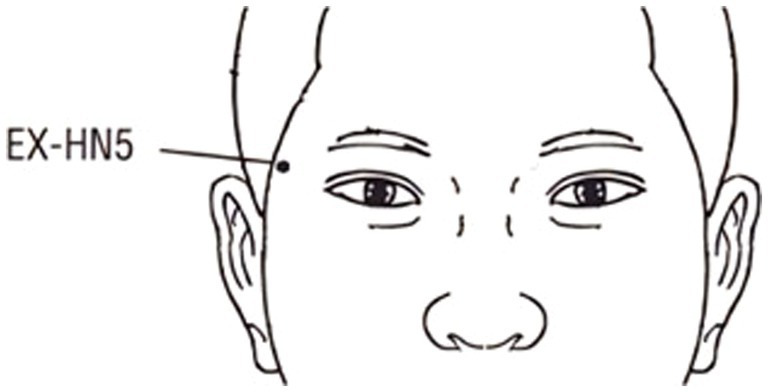 The effect of acupuncture at the <i>Taiyang</i> acupoint on visual function and EEG microstates in myopia.
