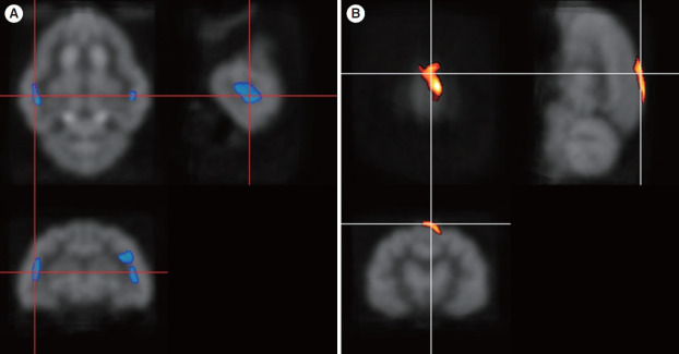 Increased Resting-State Positron Emission Tomography Activity After Cochlear Implantation in Adult Deafened Cats.