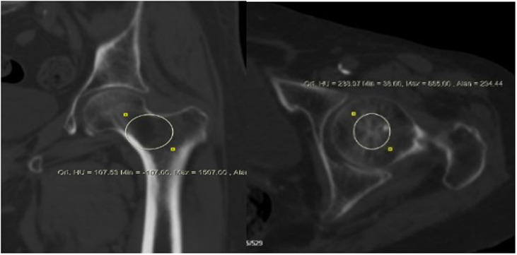 Feasibility of diagnosing osteoporosis using routine computed tomography scans for hip fractures: Correlation with histopathological diagnosis of head and neck regions.