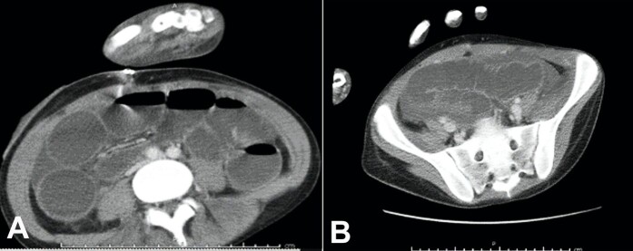 <i>Clostridioides difficile</i> infection leading to fulminant colitis with toxic megacolon.