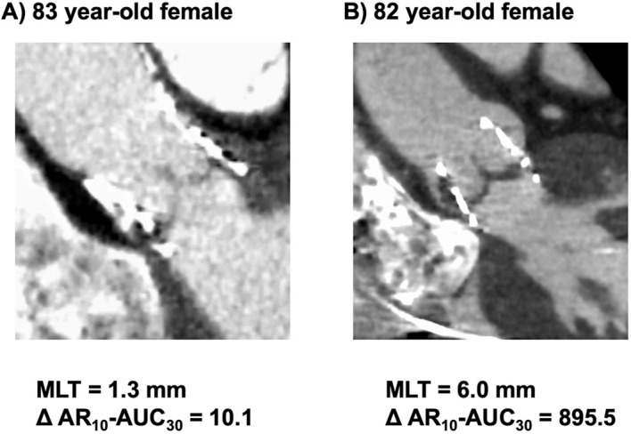 Periprocedural Thrombogenicity Change Is Associated With Subclinical Leaflet Thrombosis Progression in Patients Undergoing Transcatheter Aortic Valve Implantation.