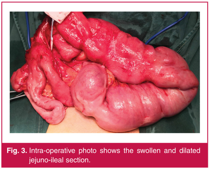 A case of spontaneous isolated superior mesenteric arterial dissection with coeliac axis stenosis.