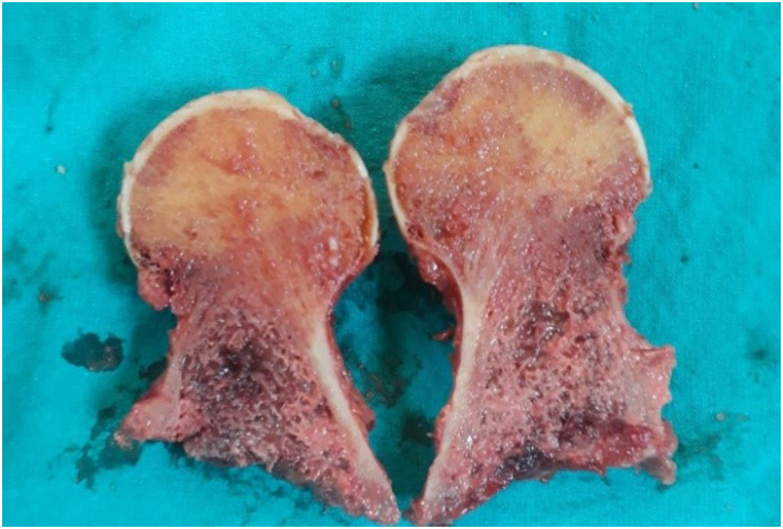 Feasibility of diagnosing osteoporosis using routine computed tomography scans for hip fractures: Correlation with histopathological diagnosis of head and neck regions.
