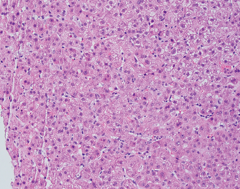 A Case of Significant Transaminitis with Liver Biopsy in a Pregnant Patient with COVID-19.