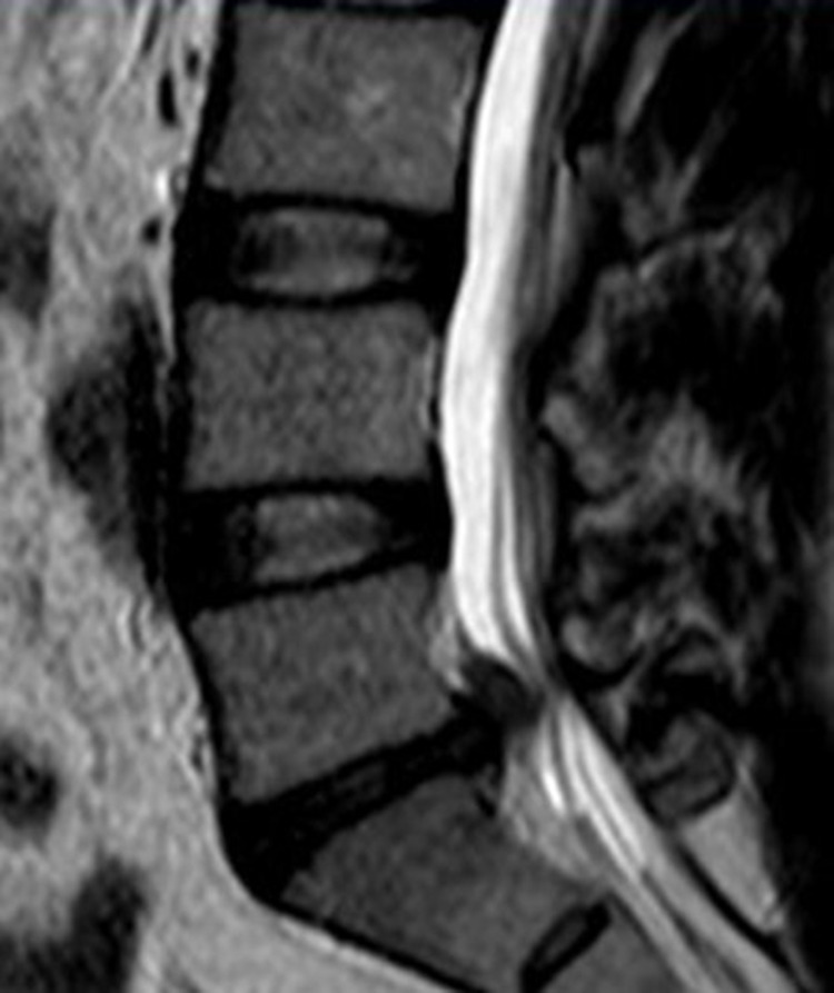 Clinical Effects of the End-Love Technique in the Treatment of Recurrent Lumbar Disc Herniation 1 Year After Surgery.