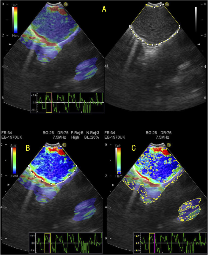 Quantitative analysis of endobronchial elastography combined with serum tumour markers of lung cancer in the diagnosis of benign and malignant mediastinal and hilar lymph nodes.