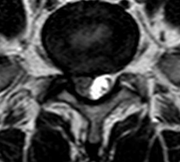 Clinical Effects of the End-Love Technique in the Treatment of Recurrent Lumbar Disc Herniation 1 Year After Surgery.