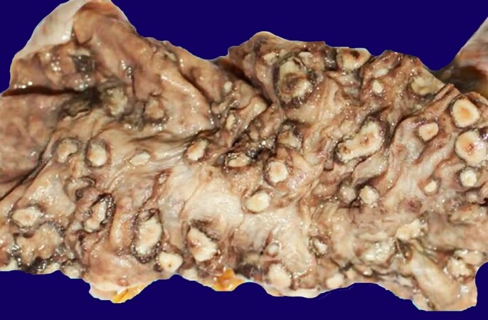 Necrotizing amebic colitis in an elder patient: an unexpected autopsy finding.