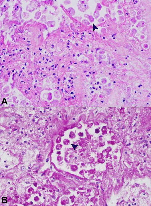 Necrotizing amebic colitis in an elder patient: an unexpected autopsy finding.