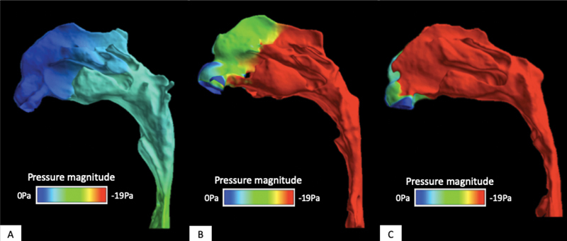 Effects of 3D Airway Geometry on the Airflow of Adults with Cleft Lip and Palate and Obstructive Sleep Apnea: A Functional Imaging Study.