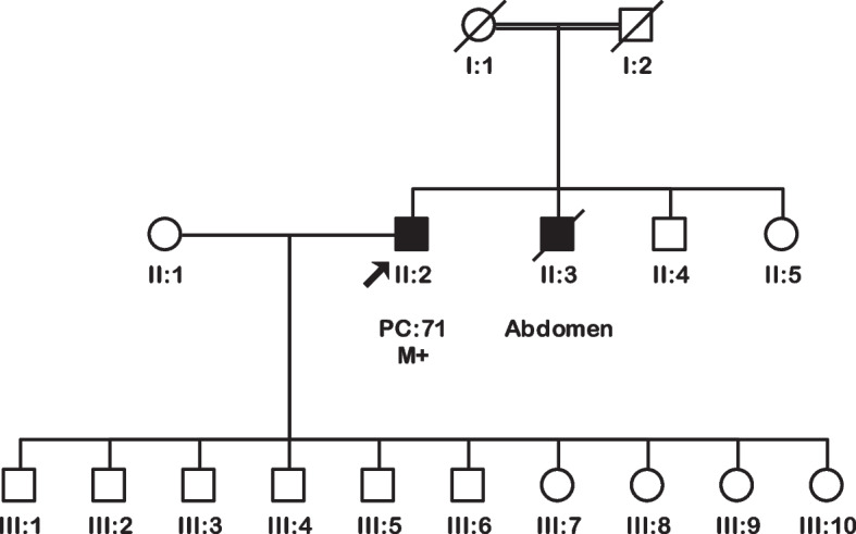 Prevalence of BRCA1 and BRCA2 germline variants in an unselected pancreatic cancer patient cohort in Pakistan.