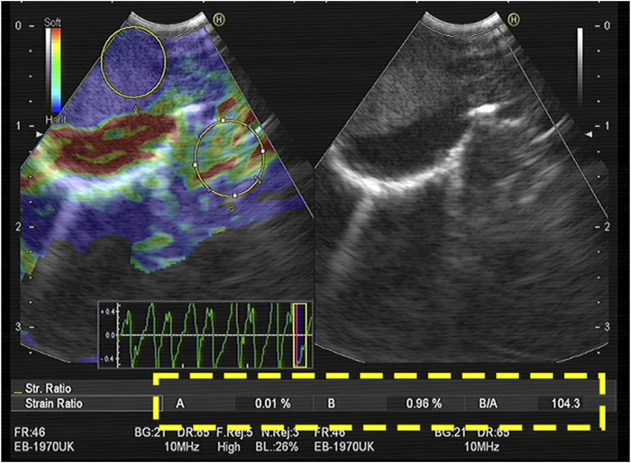 Quantitative analysis of endobronchial elastography combined with serum tumour markers of lung cancer in the diagnosis of benign and malignant mediastinal and hilar lymph nodes.