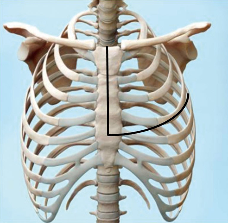 The hemiclamshell approach to bulky cervico-mediastinal lesions: how to do it.