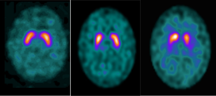 Association between body mass index (BMI) and [<sup>123</sup>I]Ioflupane (DaTSCAN) availabilities in patients with parkinsonism using single-photon emission computed tomography-computed tomography (SPECT-CT).