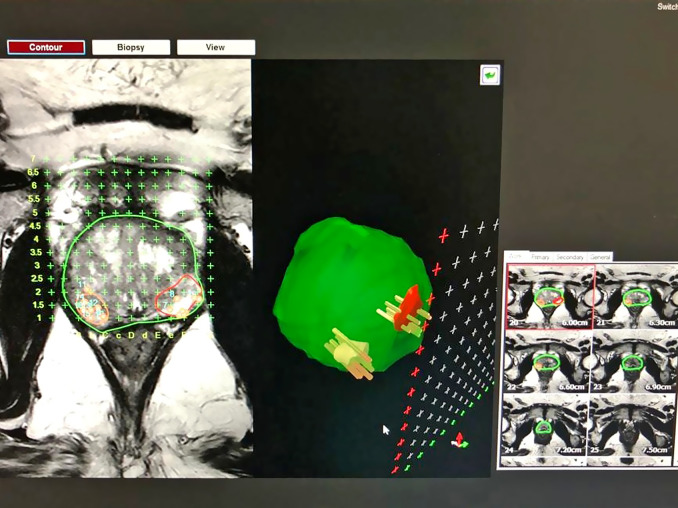 One-year Follow-up Results of Transperineal Biopsy For Patients Undergoing Irreversible Electroporation Treatment in Localized Prostate Cancer.