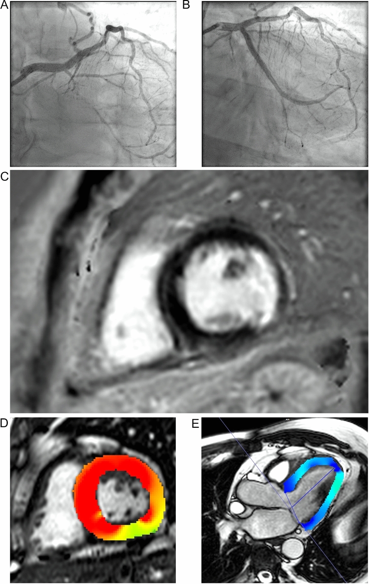 Baseline angina burden predicts quality of life and functional improvement in patients with viable myocardium treated for chronic total occlusion.